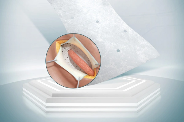 ผลิตภัณฑ์ SiS ชีวภาพสำหรับการผ่าตัดทั่วไป