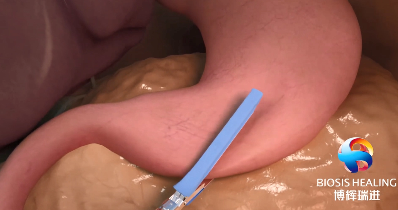 การเสริมแรงลวดเย็บกระดาษ (SLR) เพื่อลดการรั่วไหล