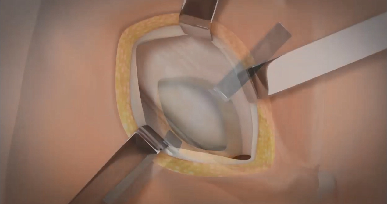 Liğhernia ซ่อมแซมด้วยตาข่ายดูดซับ SiS