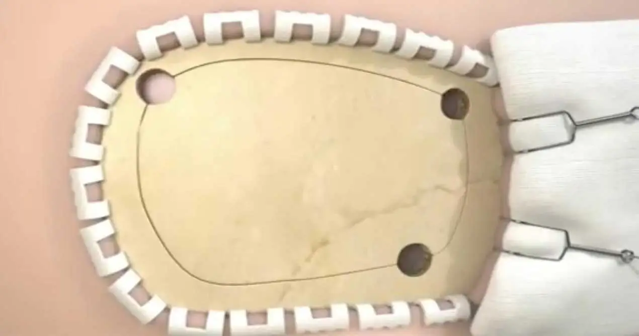 แพทช์ซ่อมแซม Dural