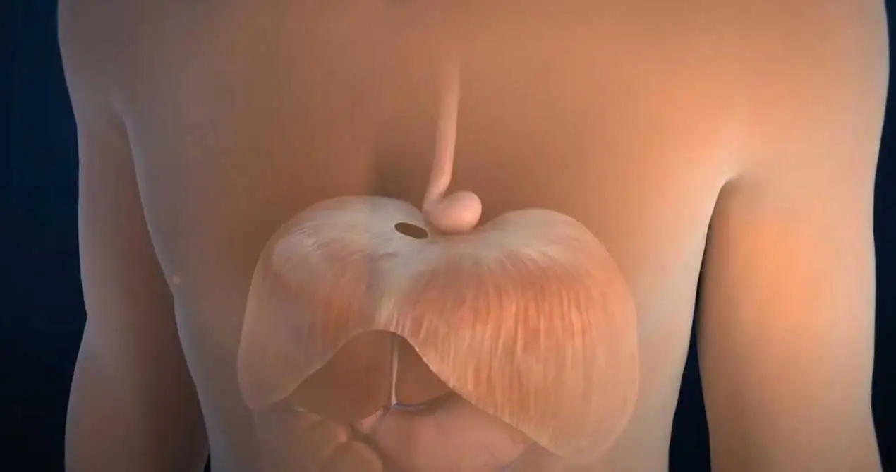 ไส้เลื่อน hiatus หลอดอาหารซ่อมแซมด้วยตาข่ายชีวภาพ SiS