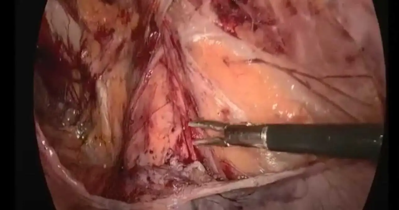 SiS Biological Mesh 13x15cm tapp ศัลยกรรมสำหรับการซ่อมแซมไส้เลื่อน