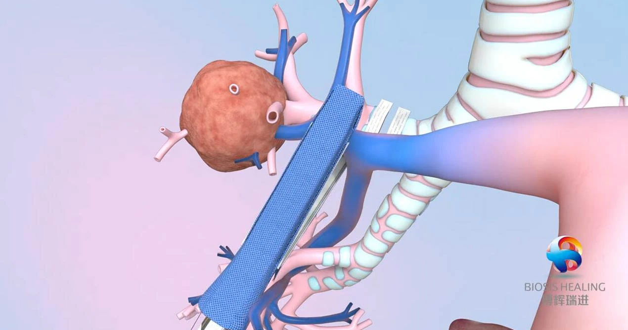 เสริมลวดเย็บกระดาษสำหรับ lobectomy